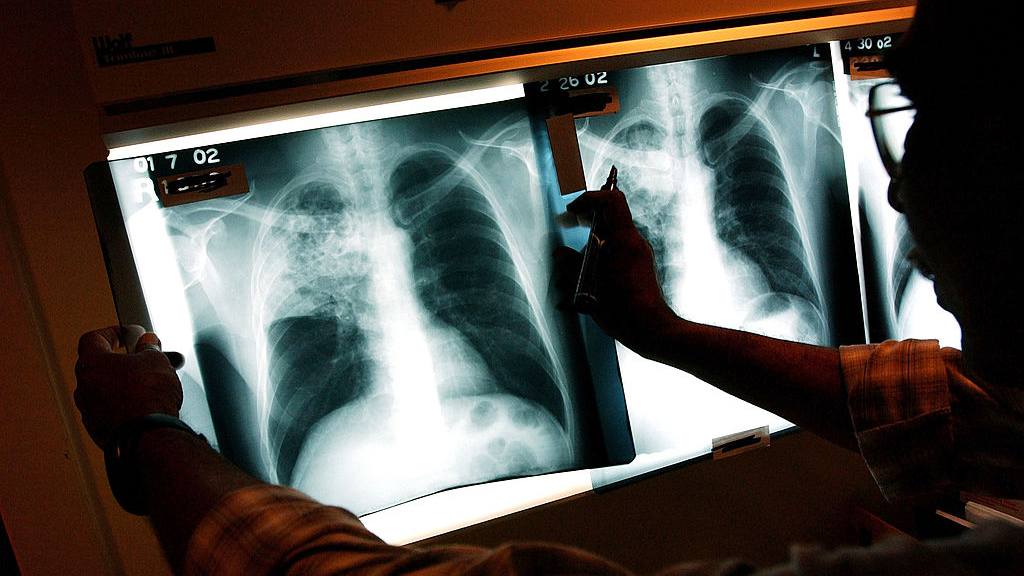 2 active tuberculosis cases traced to San Francisco strip club — KTVU FOX 2 Bay Area, Yountville Health news